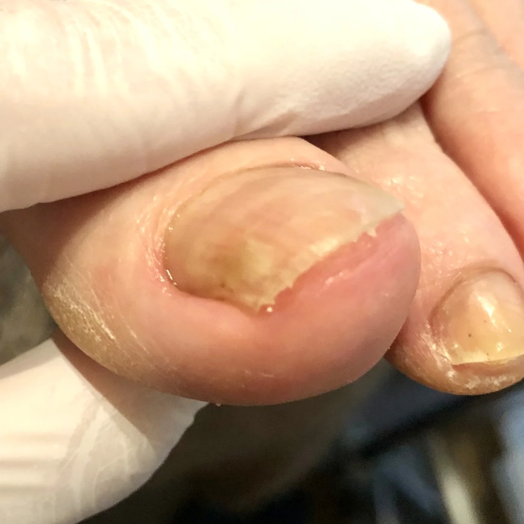 Deformed nail after