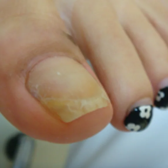 Deformed nail after