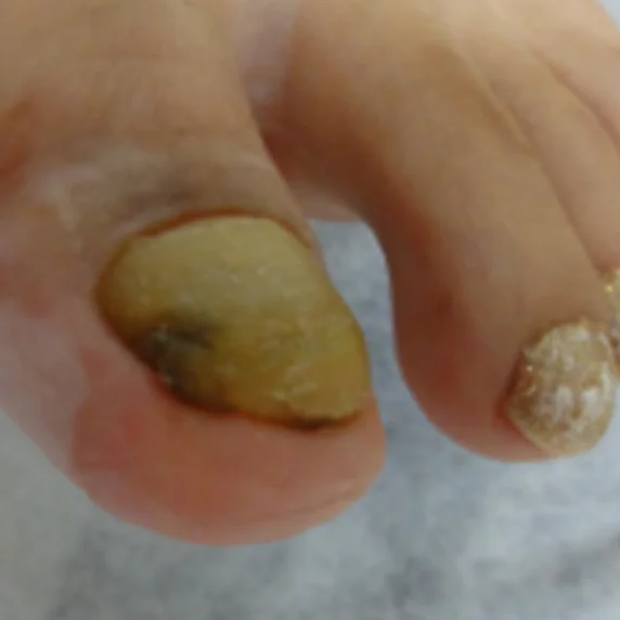 Deformed nail before