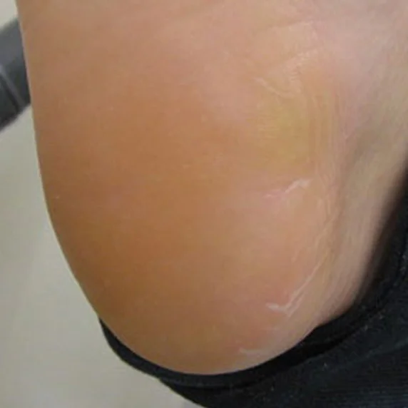 Callus care after