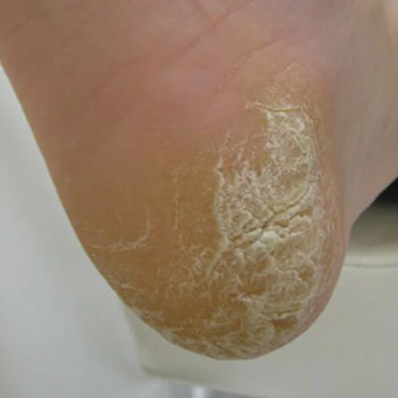 Callus care before
