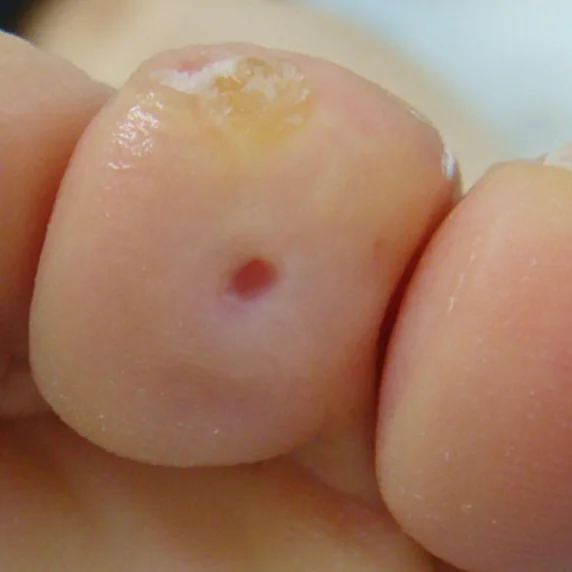 Callus and corn after