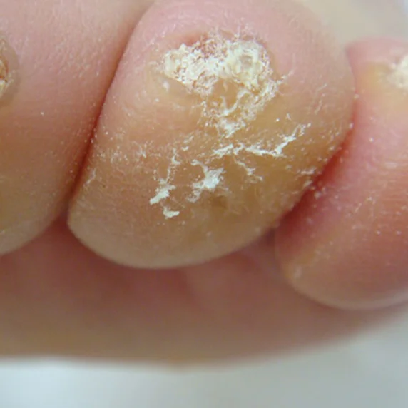 Callus and corn before