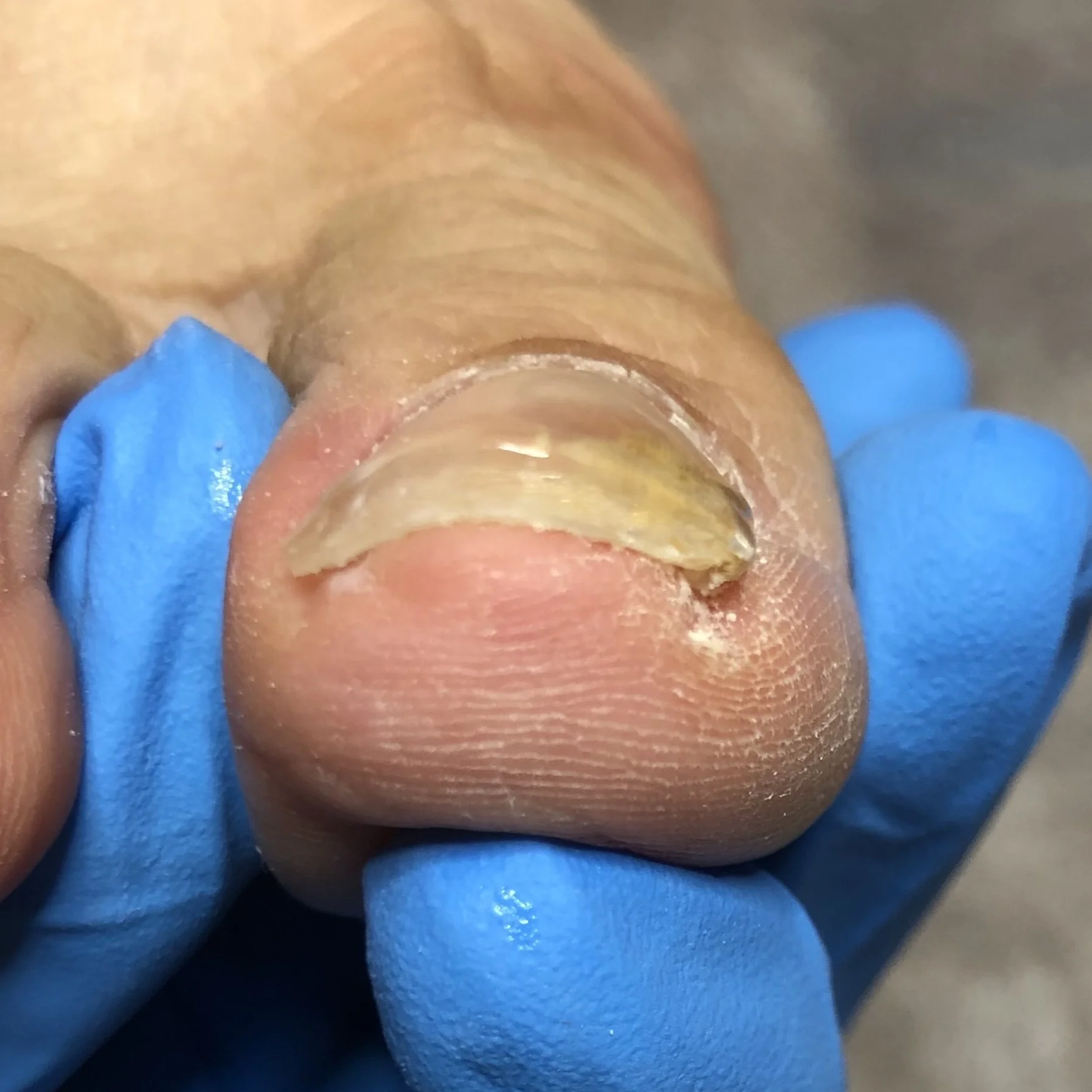 Severe ingrown toenail after