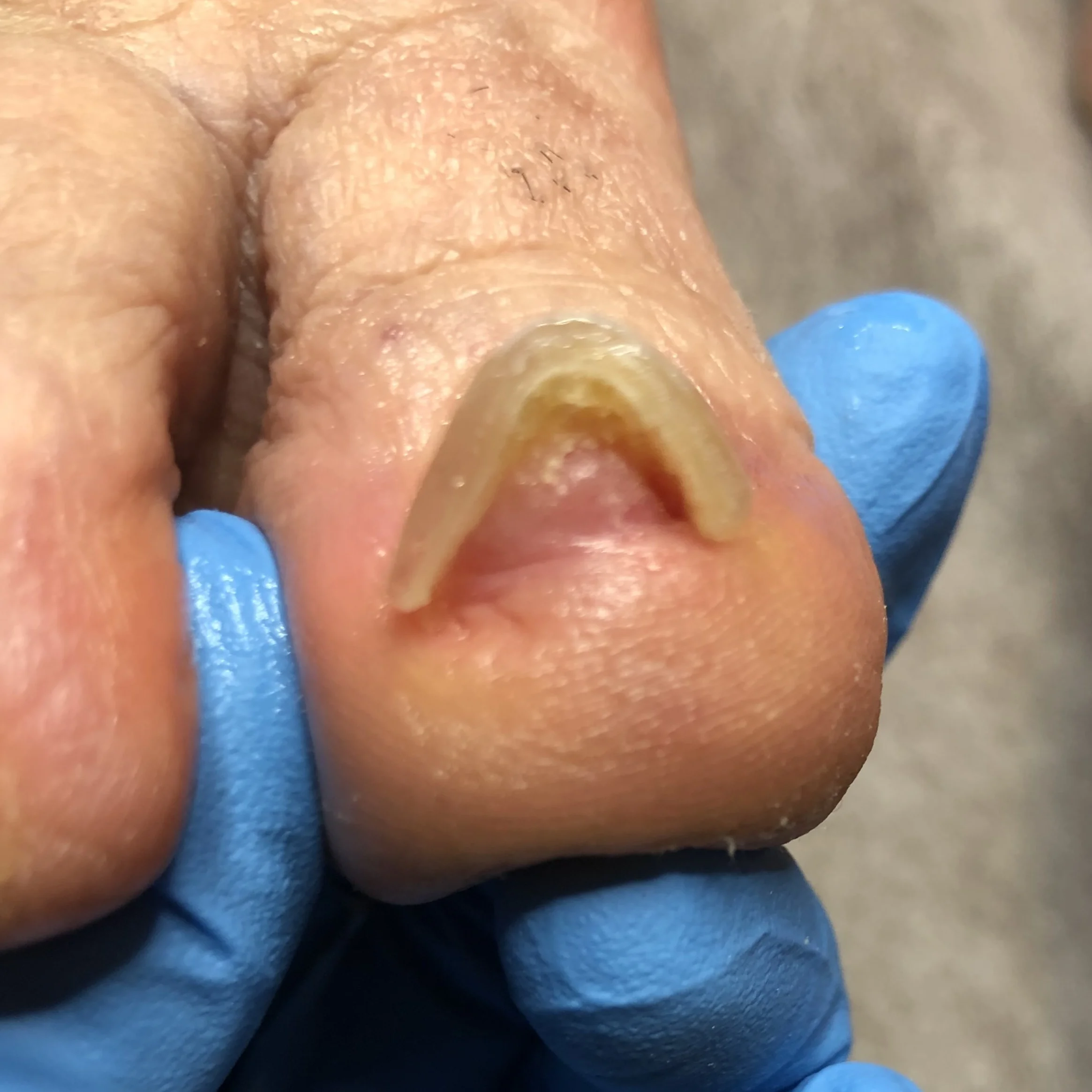 Severe ingrown toenail after