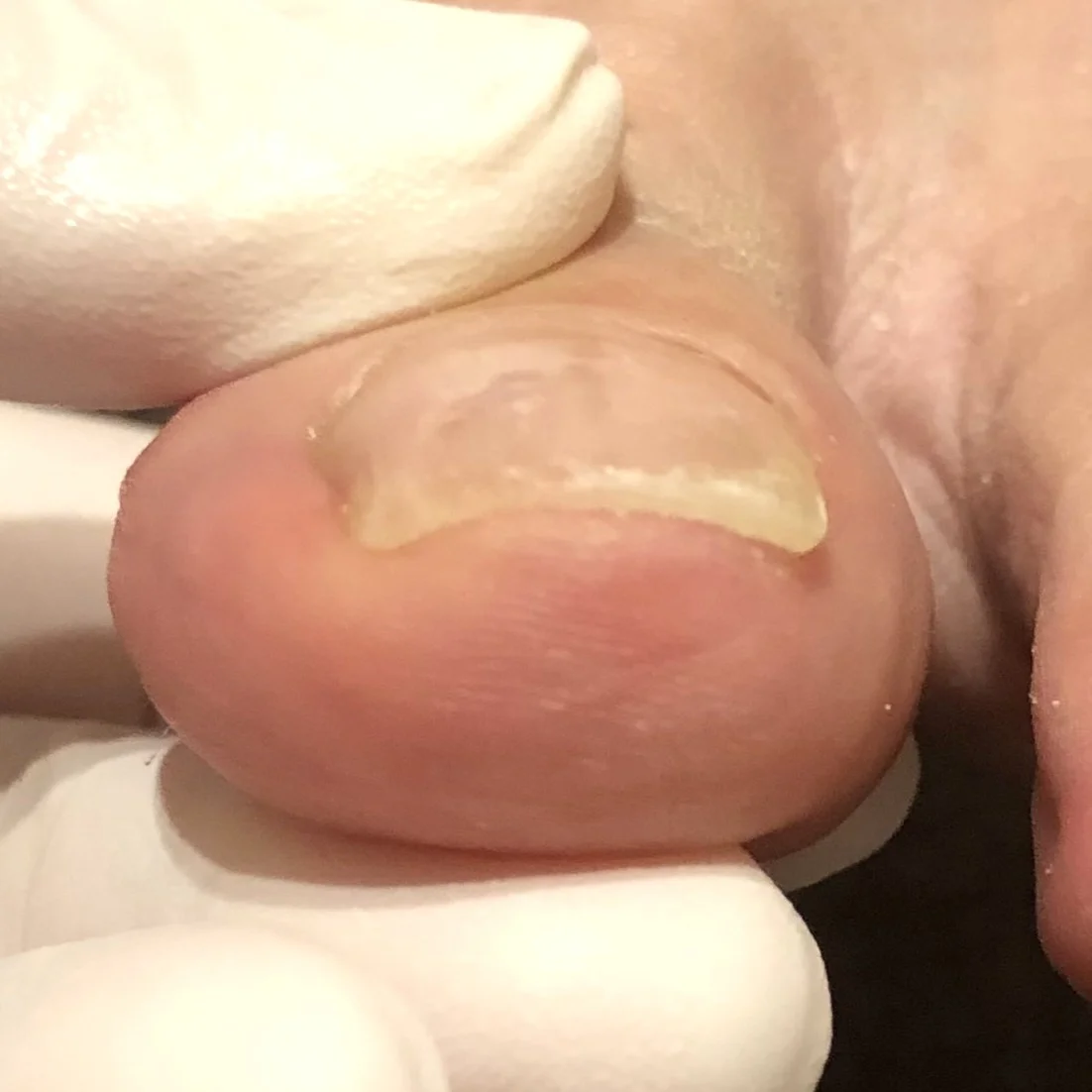 Mild ingrown toenail after