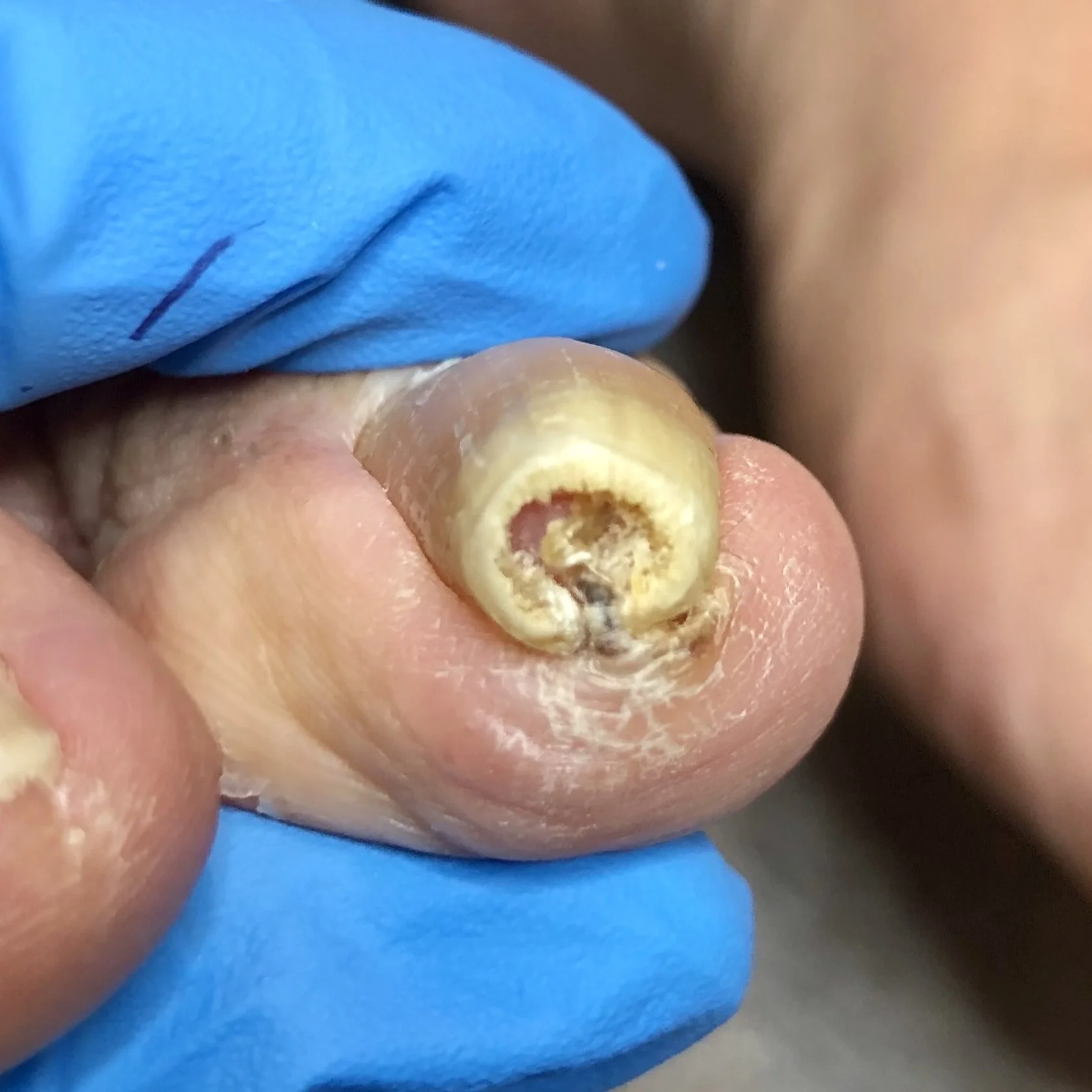 Severe ingrown toenail before