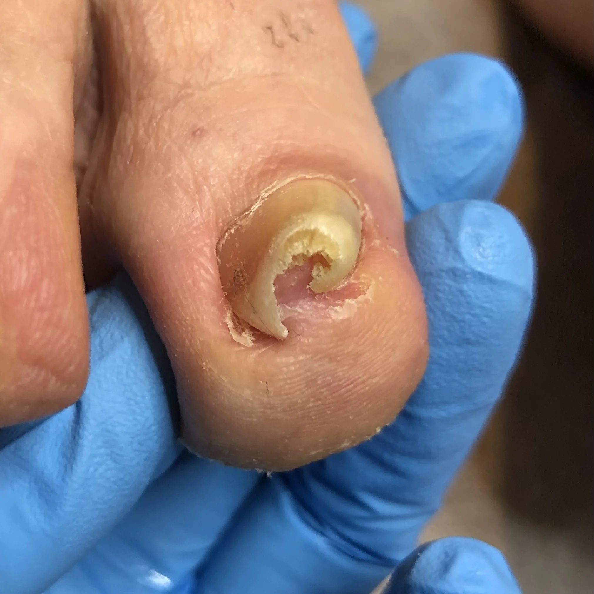 Severe ingrown toenail before