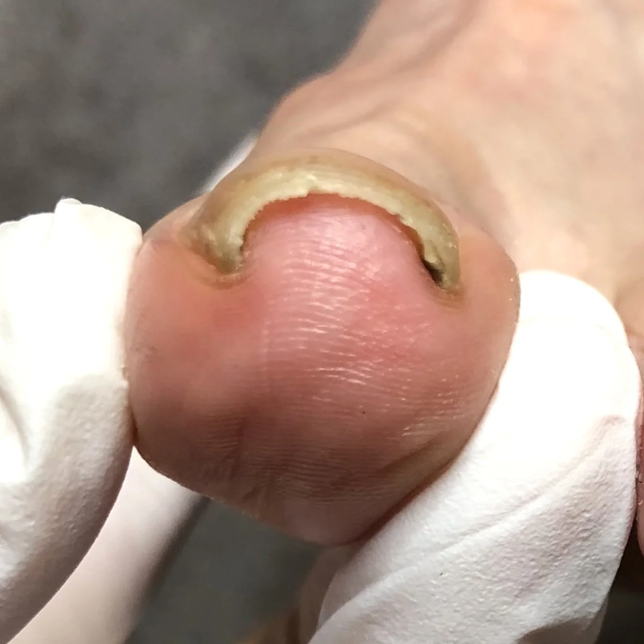 Mild ingrown toenail before