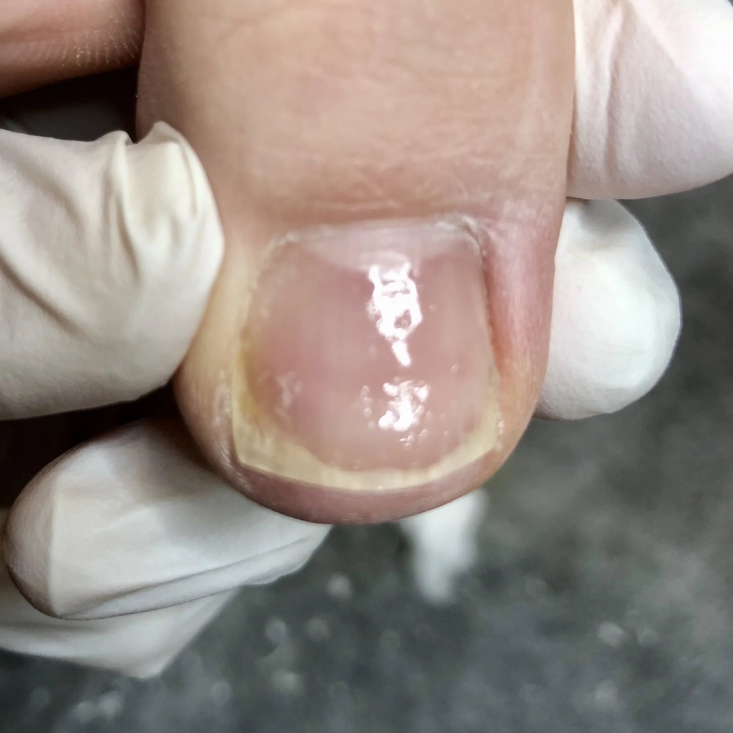 Embedded nail after
