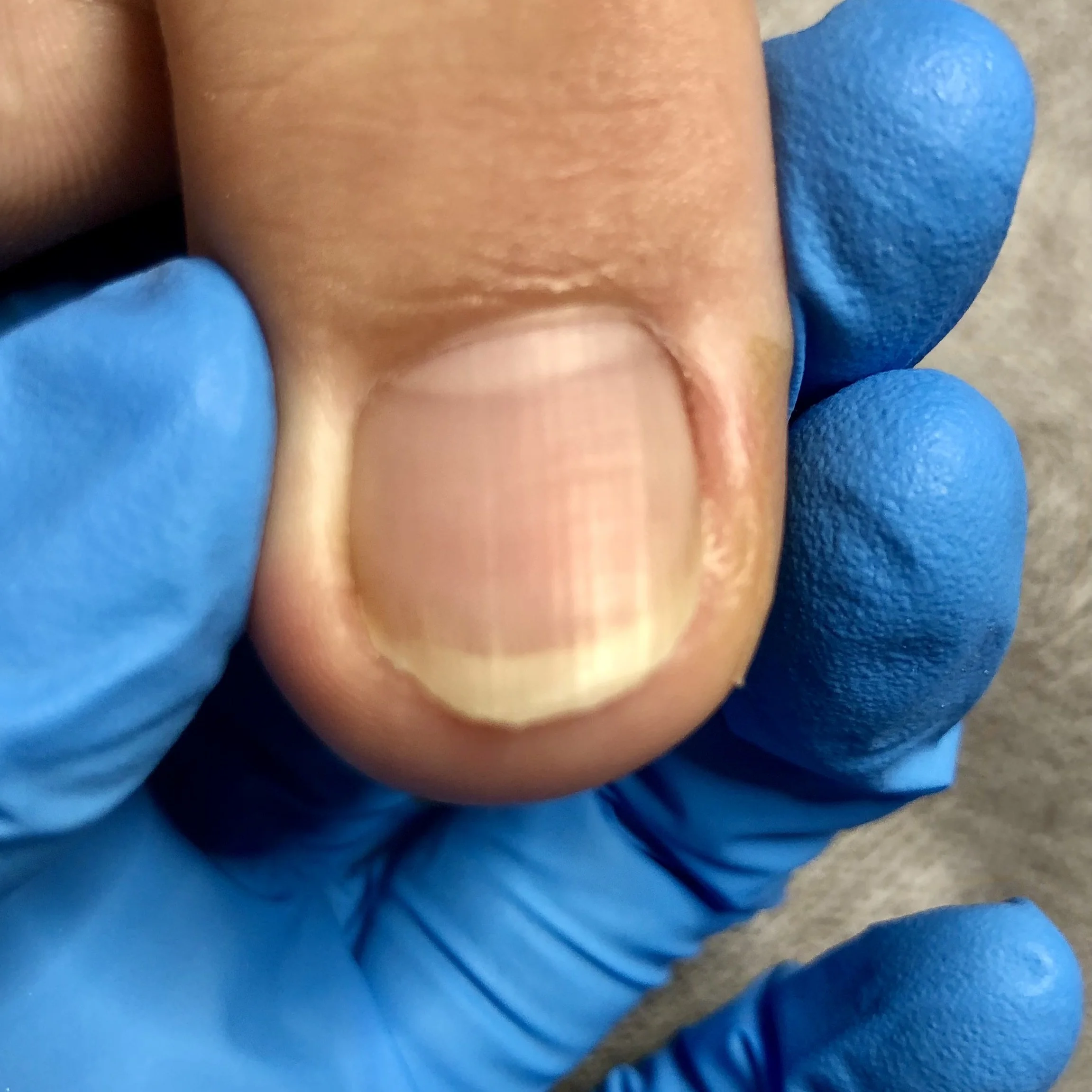 Embedded nail before