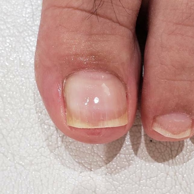 割れ爪 施術後