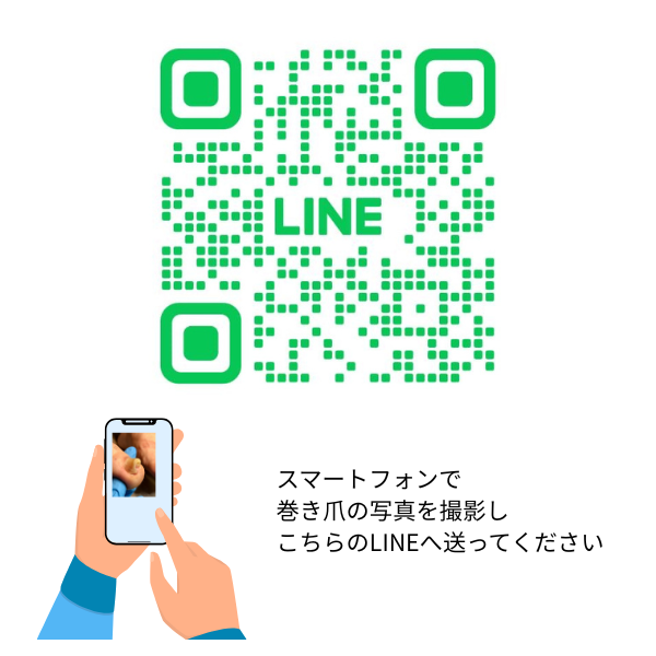 スマートフォンで巻き爪の写真を撮影し、こちらのLINEへ送ってください。